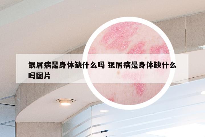 银屑病是身体缺什么吗 银屑病是身体缺什么吗图片