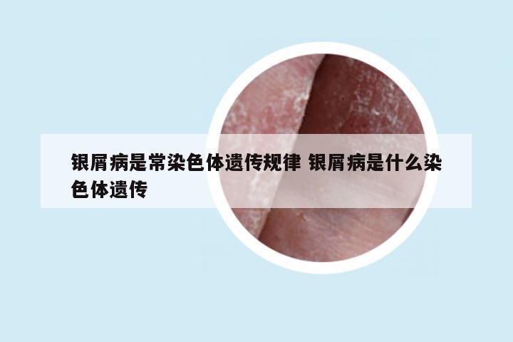 银屑病是常染色体遗传规律 银屑病是什么染色体遗传