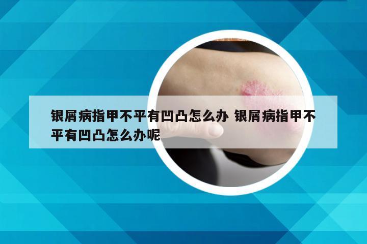银屑病指甲不平有凹凸怎么办 银屑病指甲不平有凹凸怎么办呢