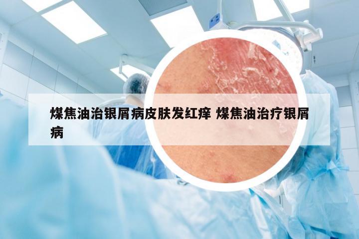 煤焦油治银屑病皮肤发红痒 煤焦油治疗银屑病