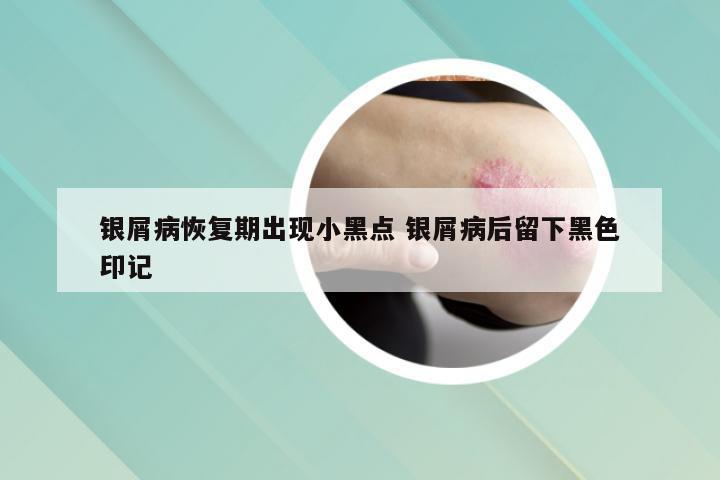 银屑病恢复期出现小黑点 银屑病后留下黑色印记