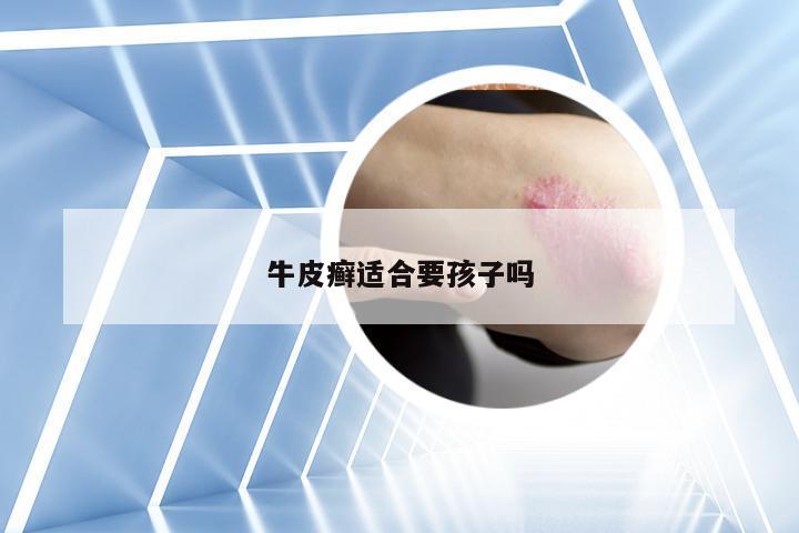 牛皮癣适合要孩子吗