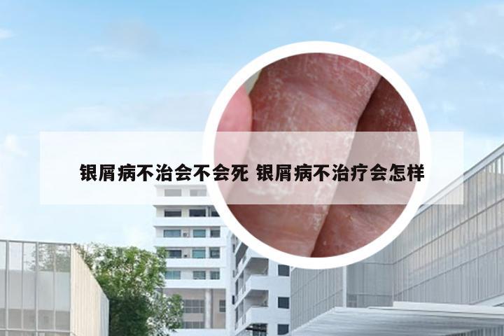 银屑病不治会不会死 银屑病不治疗会怎样