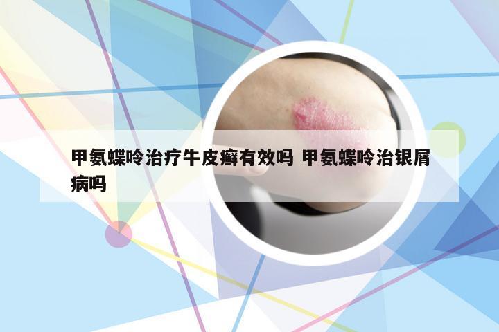 甲氨蝶呤治疗牛皮癣有效吗 甲氨蝶呤治银屑病吗