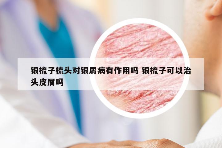 银梳子梳头对银屑病有作用吗 银梳子可以治头皮屑吗