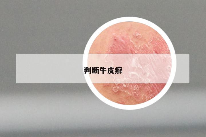 判断牛皮癣