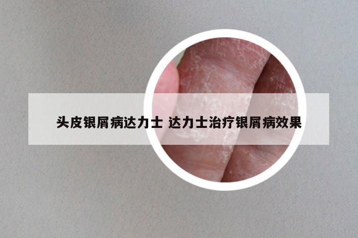 头皮银屑病达力士 达力士治疗银屑病效果
