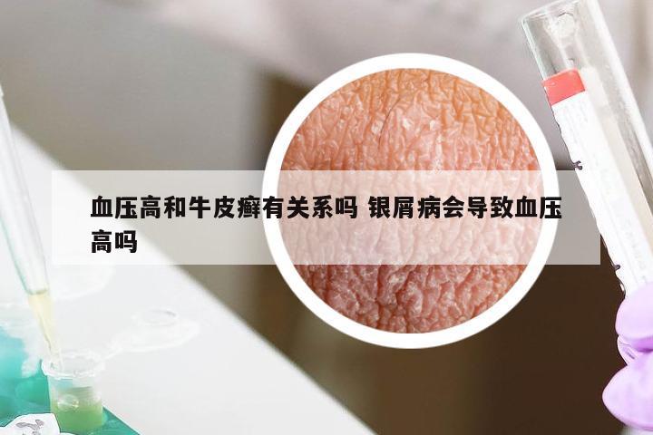 血压高和牛皮癣有关系吗 银屑病会导致血压高吗