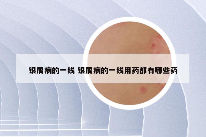 银屑病的一线 银屑病的一线用药都有哪些药
