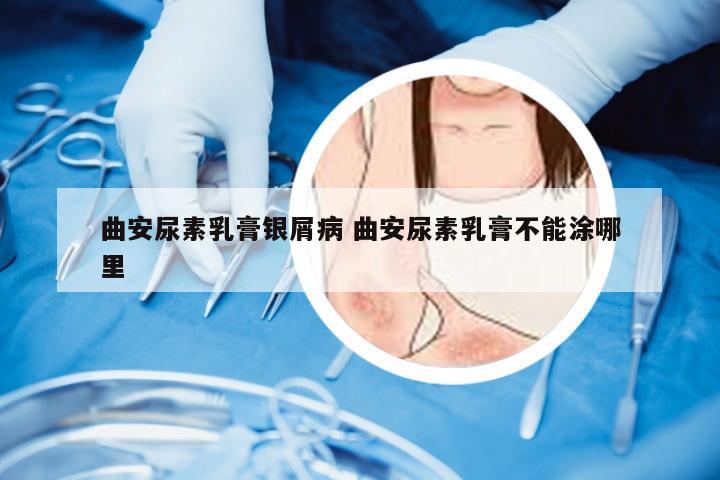 曲安尿素乳膏银屑病 曲安尿素乳膏不能涂哪里