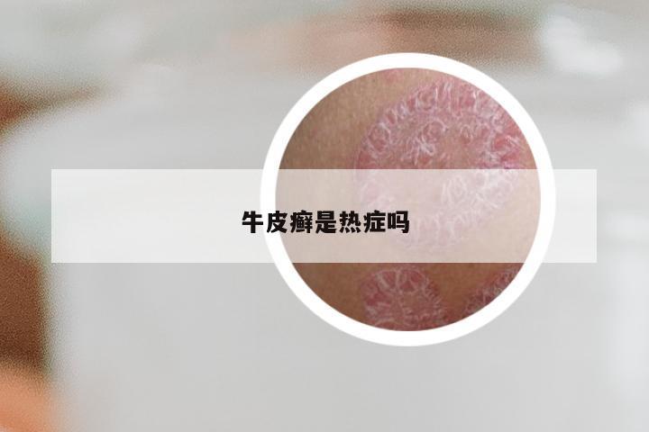 牛皮癣是热症吗