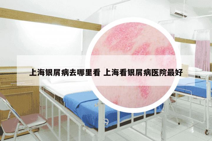 上海银屑病去哪里看 上海看银屑病医院最好