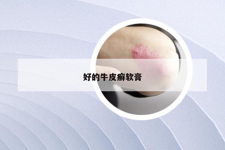 好的牛皮癣软膏