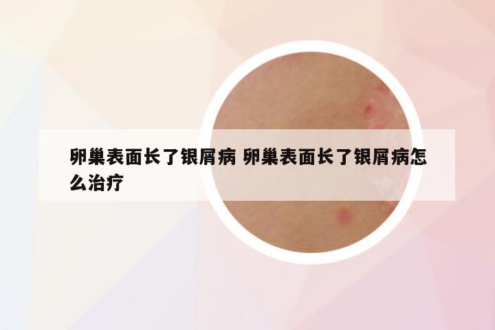 卵巢表面长了银屑病 卵巢表面长了银屑病怎么治疗