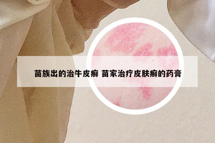 苗族出的治牛皮癣 苗家治疗皮肤癣的药膏