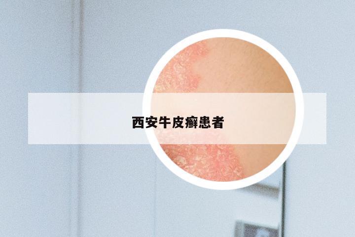 西安牛皮癣患者