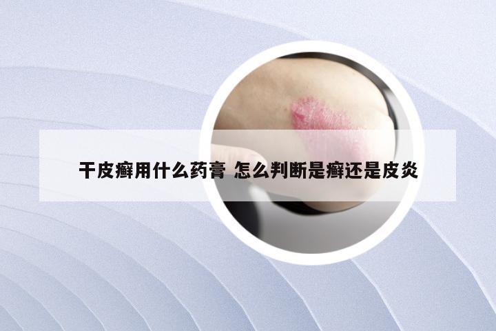 干皮癣用什么药膏 怎么判断是癣还是皮炎