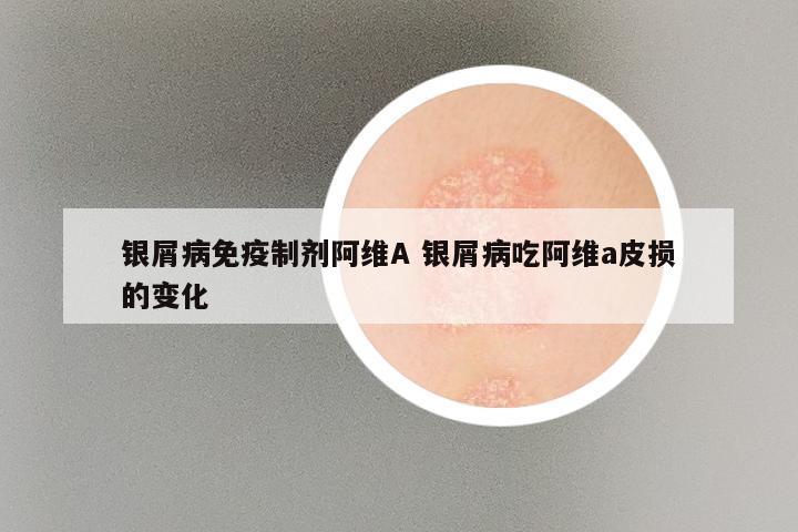 银屑病免疫制剂阿维A 银屑病吃阿维a皮损的变化