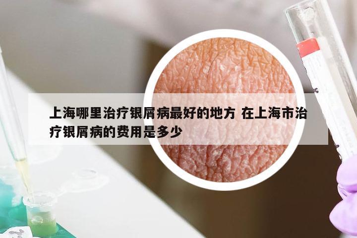 上海哪里治疗银屑病最好的地方 在上海市治疗银屑病的费用是多少