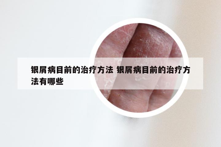 银屑病目前的治疗方法 银屑病目前的治疗方法有哪些