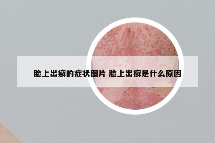 脸上出癣的症状图片 脸上出癣是什么原因