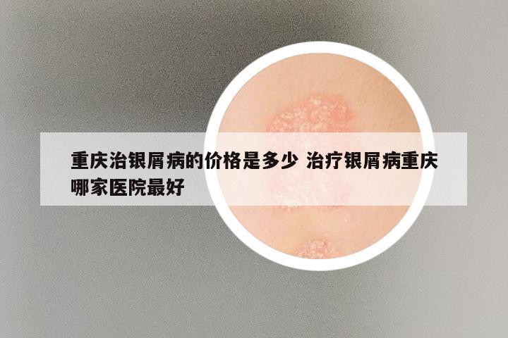 重庆治银屑病的价格是多少 治疗银屑病重庆哪家医院最好