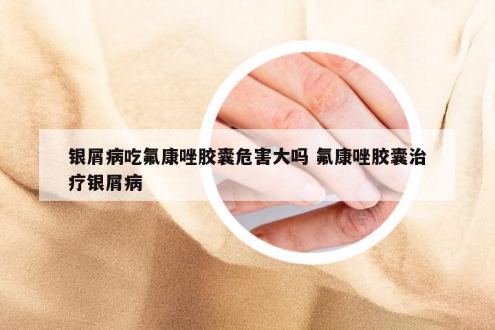 银屑病吃氟康唑胶囊危害大吗 氟康唑胶囊治疗银屑病