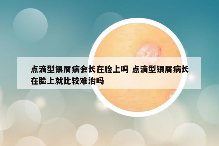 点滴型银屑病会长在脸上吗 点滴型银屑病长在脸上就比较难治吗
