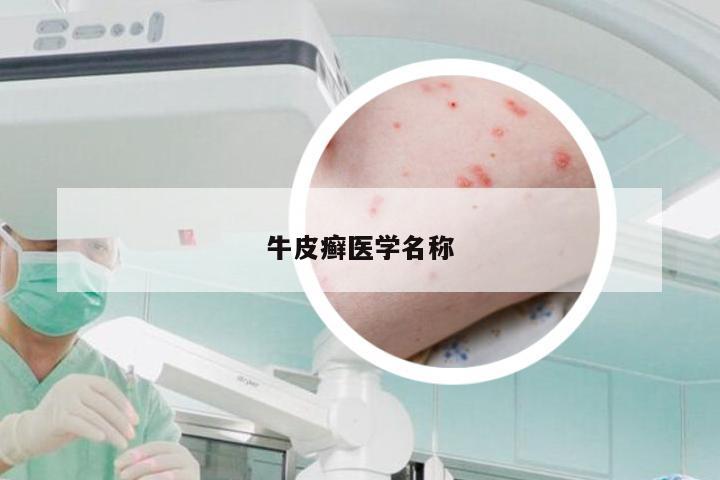 牛皮癣医学名称