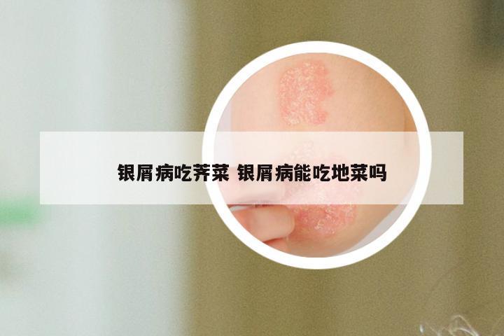 银屑病吃荠菜 银屑病能吃地菜吗