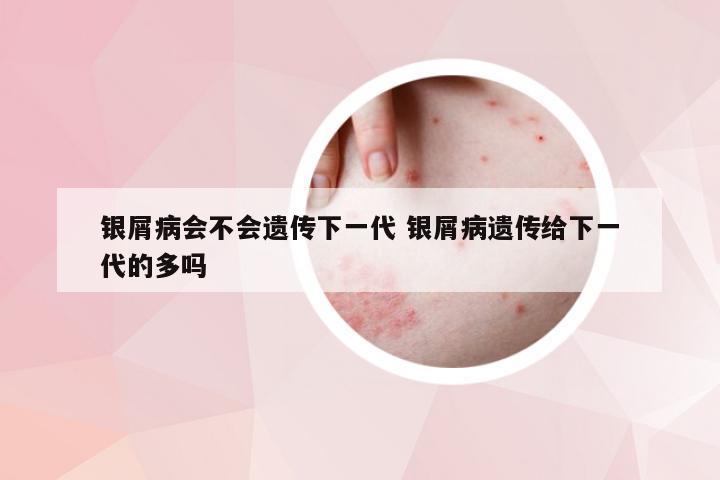 银屑病会不会遗传下一代 银屑病遗传给下一代的多吗
