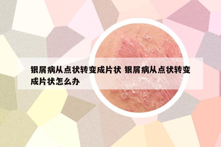 银屑病从点状转变成片状 银屑病从点状转变成片状怎么办