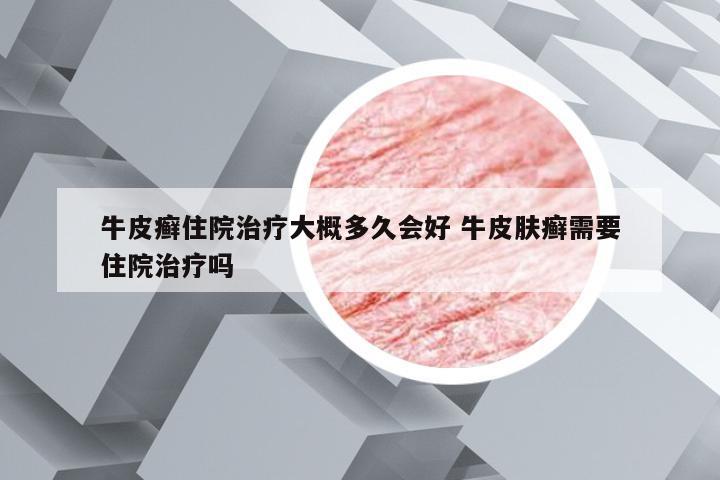 牛皮癣住院治疗大概多久会好 牛皮肤癣需要住院治疗吗