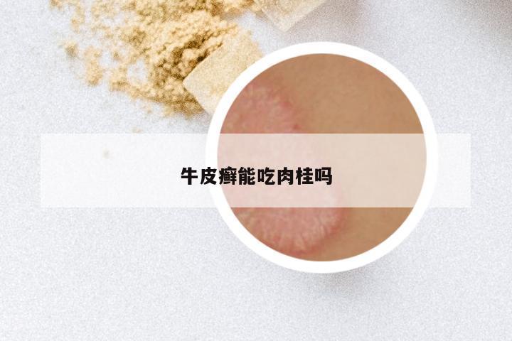 牛皮癣能吃肉桂吗