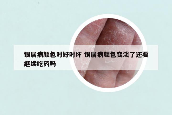 银屑病颜色时好时坏 银屑病颜色变淡了还要继续吃药吗