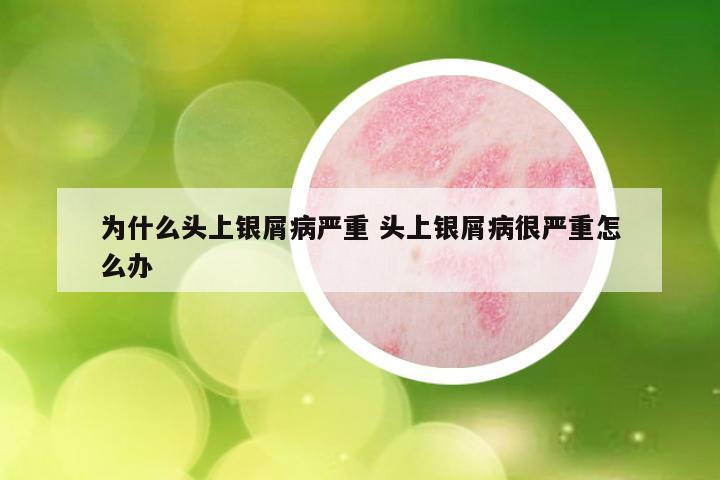 为什么头上银屑病严重 头上银屑病很严重怎么办