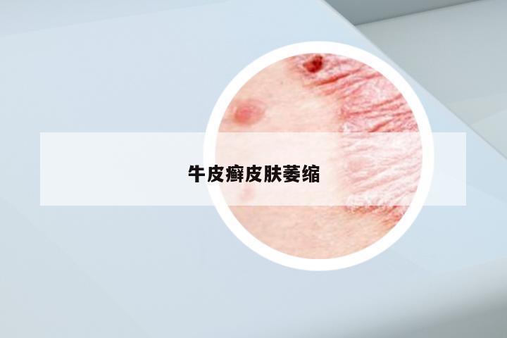 牛皮癣皮肤萎缩