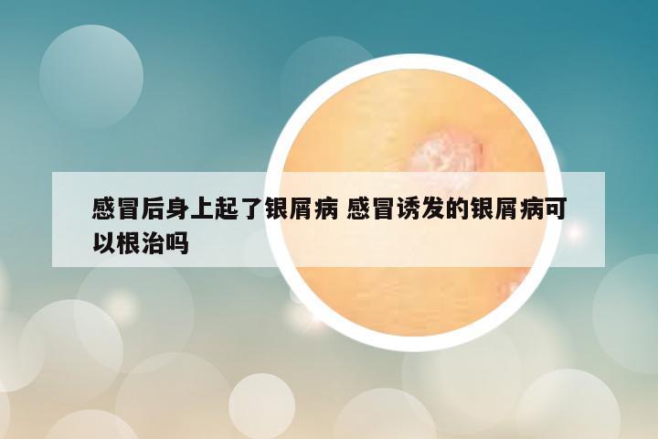 感冒后身上起了银屑病 感冒诱发的银屑病可以根治吗