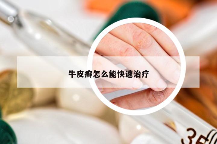 牛皮癣怎么能快速治疗