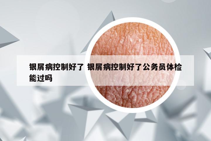 银屑病控制好了 银屑病控制好了公务员体检能过吗