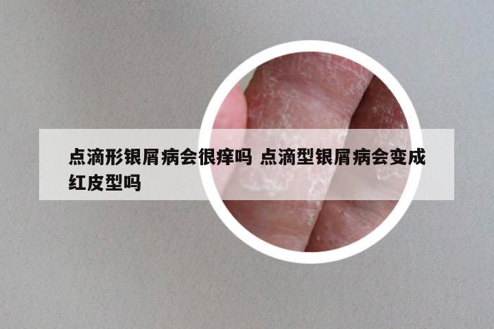 点滴形银屑病会很痒吗 点滴型银屑病会变成红皮型吗