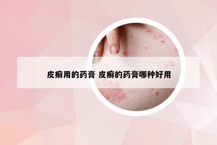 皮癣用的药膏 皮癣的药膏哪种好用