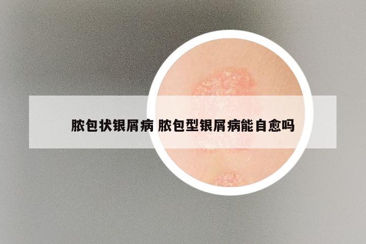 脓包状银屑病 脓包型银屑病能自愈吗