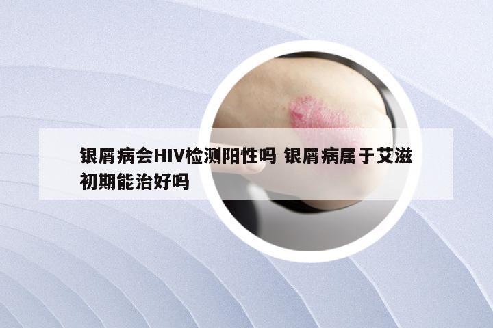 银屑病会HIV检测阳性吗 银屑病属于艾滋初期能治好吗