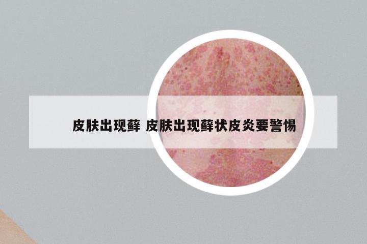 皮肤出现藓 皮肤出现藓状皮炎要警惕
