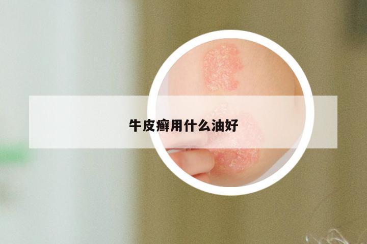 牛皮癣用什么油好