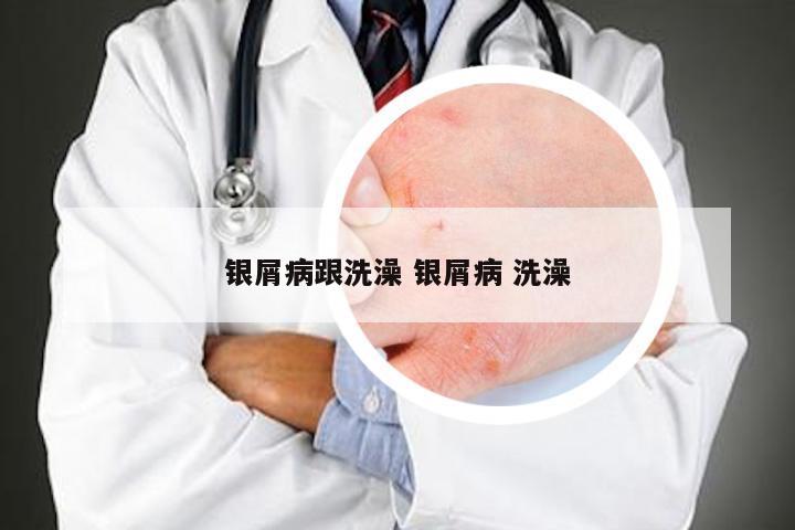 银屑病跟洗澡 银屑病 洗澡