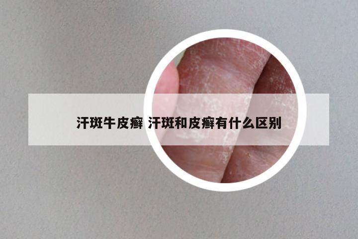 汗斑牛皮癣 汗斑和皮癣有什么区别
