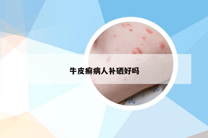 牛皮癣病人补硒好吗