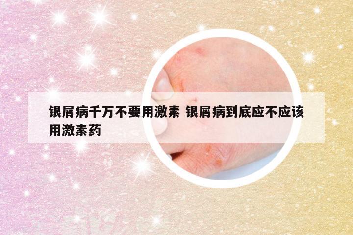 银屑病千万不要用激素 银屑病到底应不应该用激素药